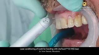 Laser conditioning of tooth for bonding with LiteTouch™ Er:YAG laser