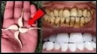 2 Minutes Effective Recipe to make dirty yellow teeth white and shiny Teeth Whitening at Home