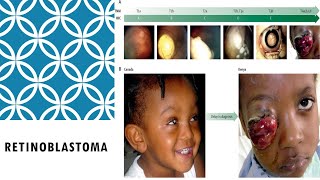 RETINOBLASTOMA pada ANAK