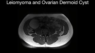 Leiomyoma and Ovarian Dermoid Cyst: