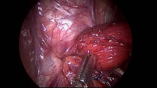 laparoscopic fundoplication for Hiatus hernia.