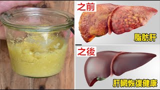 專家：這食物竟逆轉脂肪肝、預防肝癌！遠離肝臟病變，一輩子遠離肝癌！