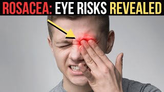 Surprising Truth About Ocular Rosacea Treatment