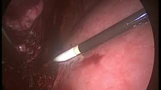 Hepatocellular carcinoma  -  laparoscopic biopsy after FNAC  was inconclusive