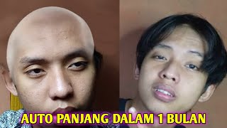 CARA MENCEGAH DAN MENGATASI RAMBUT BOTAK