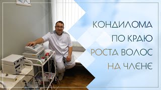 ↪ Кондилома по краю роста волос на члене. Клинический случай №87