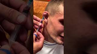 Cauliflower ear draining Pt. 2 👂🏼 💉