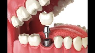 รากฟันเทียมแบบไหน เหมาะสมกับคุณ dental implant