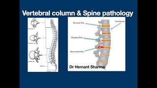 Day 1 Workshop on Disorders, Pathology of Spine & Vertebral column by Dr Hemant Sharma