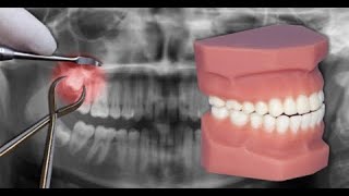 dentist extract his wisdom teeth by himself without pain and without blood by dr naser homsi 2021