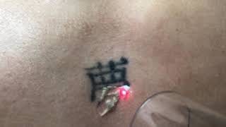 Chinese character laser tattoo removal on Asian male