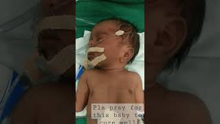 preterm baby#pray for this baby😭😭😭😭😭😭##trendingshorts #pls like subscribe 👍👍👍👍👍