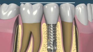 Ajuste oclusal implante