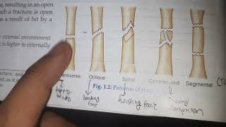 Fracture and Types of Fracture: Orthopedics Note for MBBS Final year