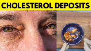 How to Remove Cholesterol Deposits Around Eyes Naturally   Get Rid of Xanthelasma at Home