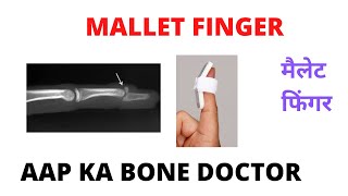 MALLET FINGER-  EPISODE 2