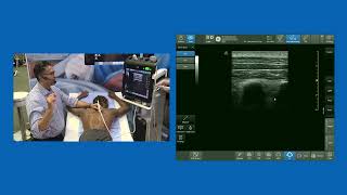 MTP (Mid-point  between Transverse process & Pleura) Block - aka:  InterTransverse Plane (ITP) Block