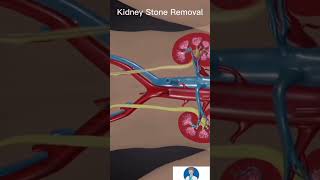 3D Process of Kidney Stones Removal | Medical Thug Life