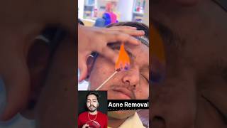 Acne Removal Viral Video #shorts #shortsvideo #shortsviral