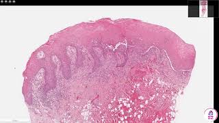 Pemphigus vulgaris