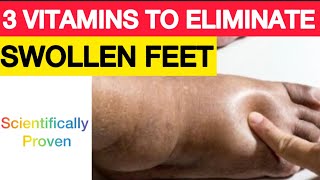 Best 3 Vitamins To Eliminate Swollen Feet Fast | Natural Remedies | Herbs & Spices