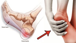 درد کف پاتو درمان کن | خار پاشنه یا التهاب پاشنه ی پا رو با تمرین ساده یوگا از بین ببر