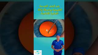 #المياه_البيضاء #cataract #علاج #طب #ترند #trending #عملية #ليزك #عيون