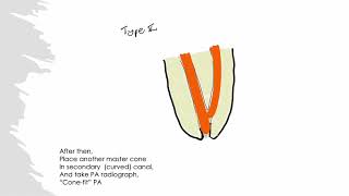 Type 2 obturation using bioceramic sealer