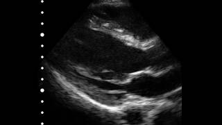 Cardiac echography - Clarius portable ultrasound