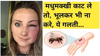 TREATMENT OF HONEY BEE 🐝 || मधुमक्खी काट ले तो क्या करें || INSECT BITE ||  घरेलू उपाय🐝