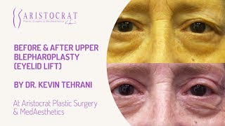 Before & After Upper Blepharoplasty Long Island, New York by Dr. Kevin Tehrani