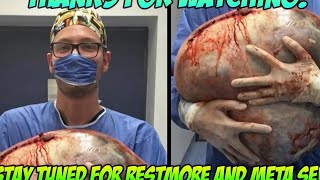 World's Largest Cyst! 130 Pound Cyst Removal Case Study!