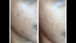 Soniclear by Michael Todd True Organics Review - incredible results in 3.5 weeks