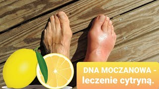 Dna moczanowa - leczenie cytryną. Czy jest skuteczne?