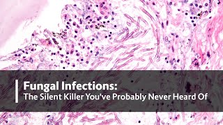 Fungal Infections: The Silent Killer You've Probably Never Heard Of