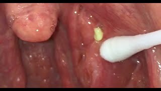 Worst Tonsil Stones! Tonsillolith Questions & Answers