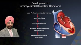 LV Thrombus vs. Intra-Myocardial Dissection Hematoma after STEMI