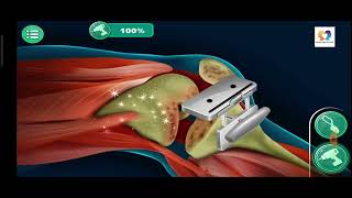 Broken Knee Be Fixed Surgery 3D Animation | #3danimation #brokenknee