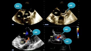 Tips and tricks: Direct Coronary Visualization with Transthoracic Echo