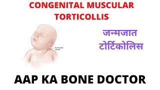 CONGENITAL MUSCULAR TORTICOLLIS - EPISODE 9