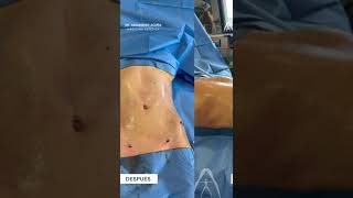 Dr. Alejandro Acuña | VASER LIPO