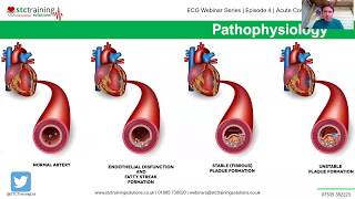 ECG Webinar Series | Episode 4 | Acute Coronary Syndromes