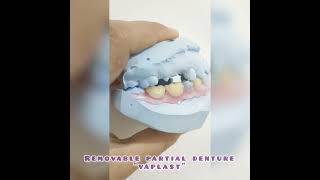 WDC_POSTERIOR REMOVABLE PARTIAL DENTURE "VAPLAST #wdc #dentist #shorts #prosthodontics