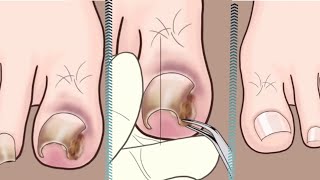 Ingrown Toenail Home  Treatment And Removal Surgery | Step by step.