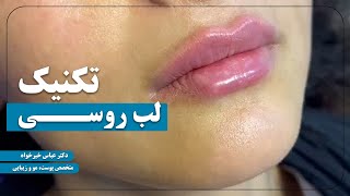 تزریق ژل لب مدل روسی