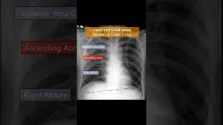 Heart ❤️ border in CXR (Part 3) #shorts #cxr #mbbs