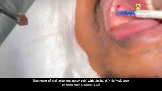 Treatment of oral lesion (no anesthesia) with LiteTouch™ Er:YAG laser