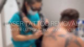 LASER TATTOO REMOVAL | METROPOLIS DERMATOLOGY