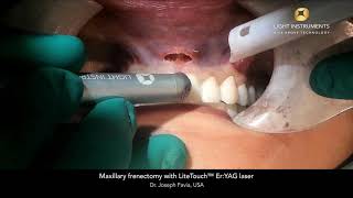 Maxillary frenectomy with LiteTouch™ Er:YAG laser