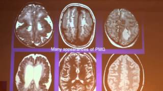 Prenatal MRI In The Diagnosis Of Malformations Of Cortical Development - Liat BEN SIRA Part 3